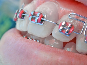 Apparecchio dentale fisso