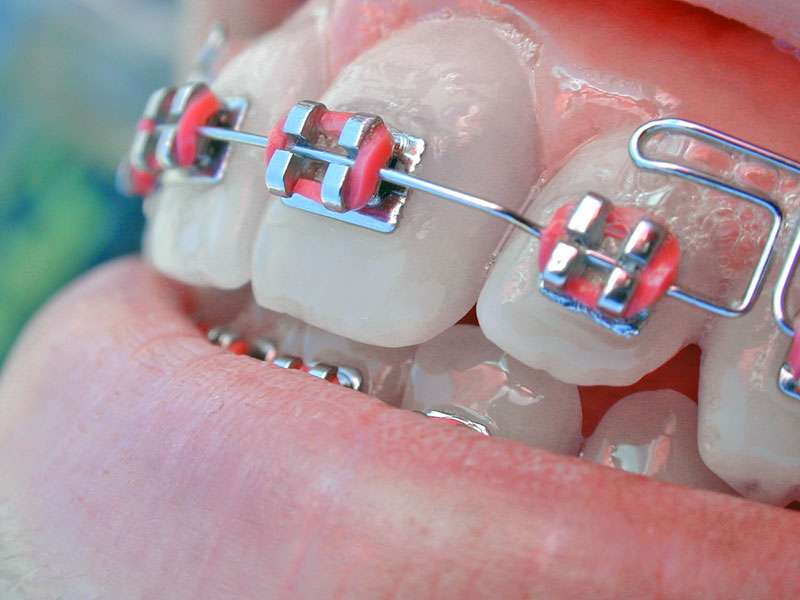 Apparecchio ortodontico dentale con dentiera Allineamento denti,  apparecchio dentale, apparecchio ortodontico, trainer, apparecchio dentale,  allineatore