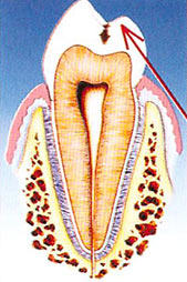fase iniziale carie dentale