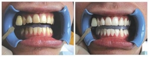 sbiancamento professionale denti