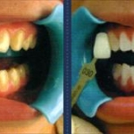 sbiancamento professionale denti