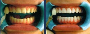 sbiancamento professionale denti