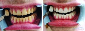 sbiancamento professionale denti