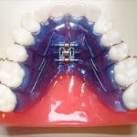 apparecchio dentale mobile