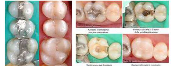 conservativa per carie dentale dott. marco dormi