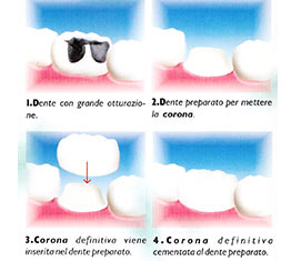 estetica dentale corona dente