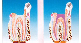 terapia canalare dente dott. marco dormi odontoiatra