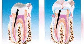 cura canalari denti dott. marco dormi odontoiatra