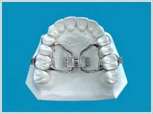 apparecchio dentale espansore palatale