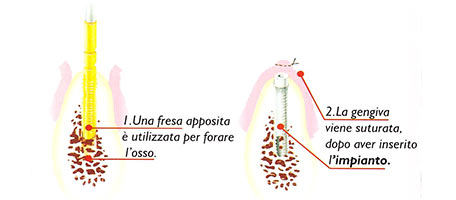 tecnica impianti dentali 