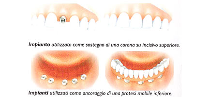 tipologie impianti dentali dott. marco dormi