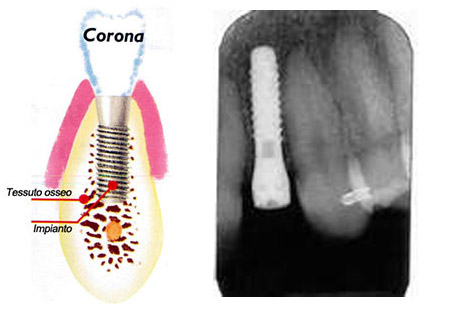 impianti dentali implantologia dott. marco dormi