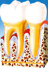 parodontite malattia parodontale