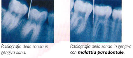 radiografia malattia parodontale