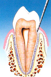 parodontite terapia dott. marco dormi odontoiatra