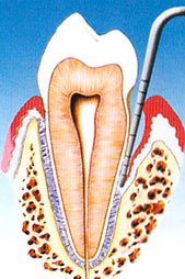 parodontite terapia