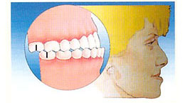 occlusione dente