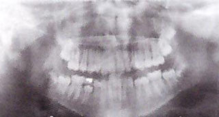 radiografia panoramica denti