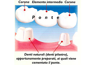 ponte dentale cos'è