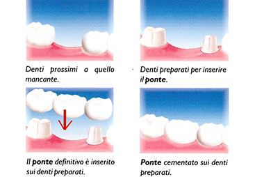 ponte dentale provvisorio